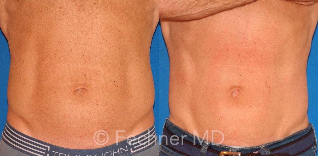 Emsculpt Before and After 01