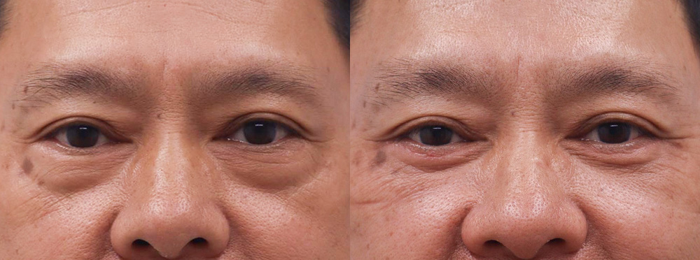 Eyelids Before and After 04
