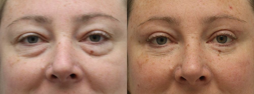 Eyelids Before and After 19