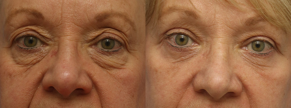 Eyelids Before and After 10