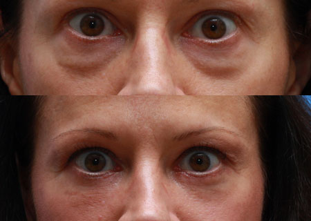 Eyelids Before and After 12