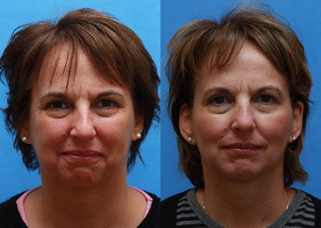 Face Before and After 33