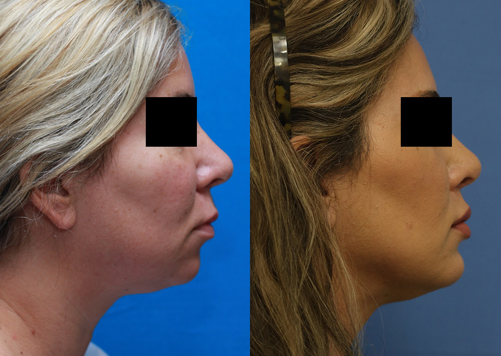 Facial Implants Before and After 10