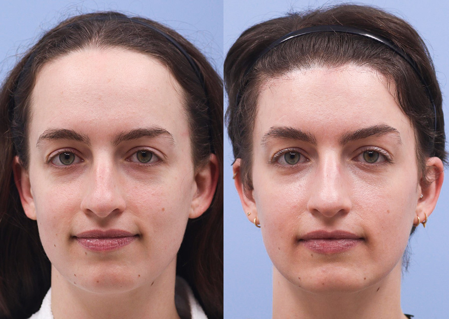 Forehead Reduction Before and After 02