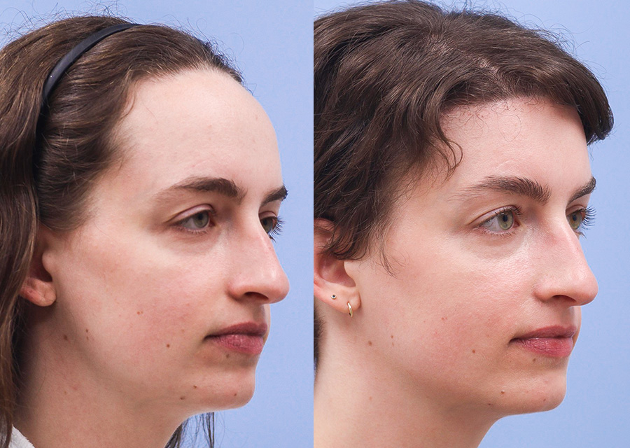 Forehead Reduction Before and After 03