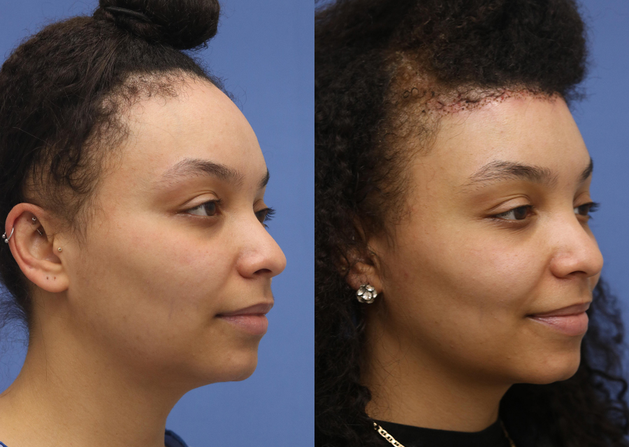 Forehead Reduction Before and After 05