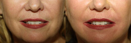 Lips Before and After 10